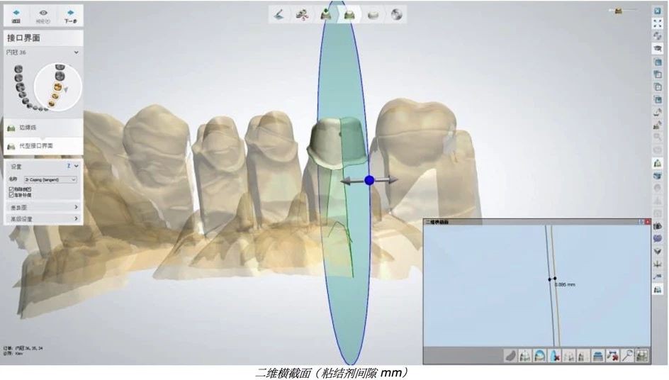 3Shape Dental System 2018 【操作方法】- 解剖型内冠和基底冠