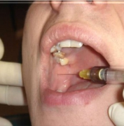拔牙时常用的麻醉方法有哪些？