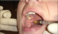 拔牙时常用的麻醉方法有哪些？