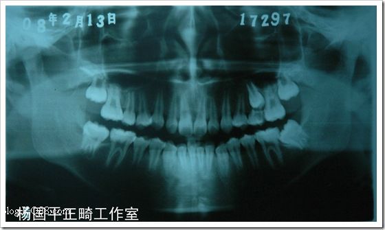 MBT技术治疗双颌前凸病例（二）