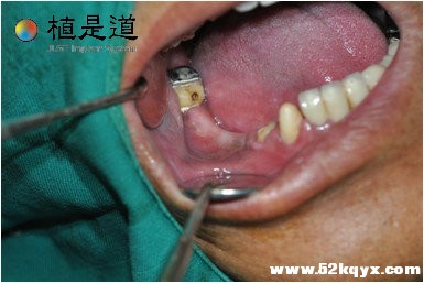 术前口腔牙齿状况