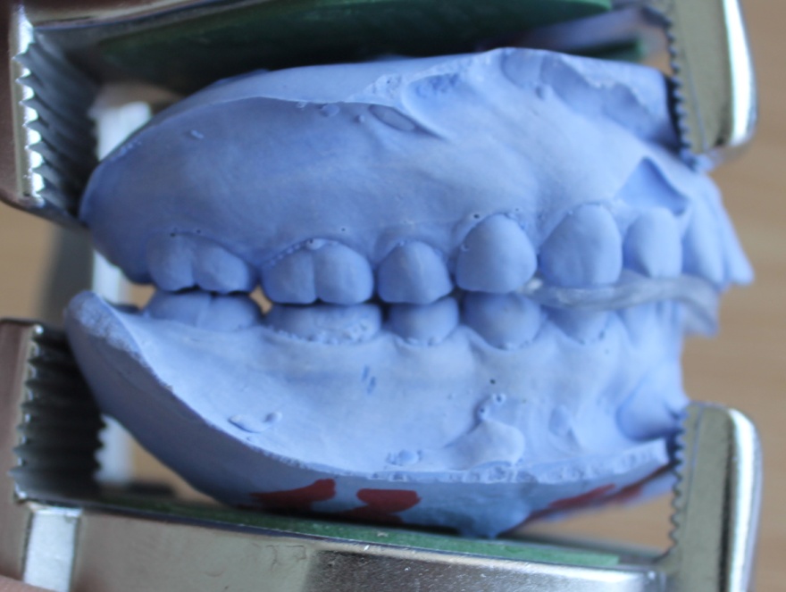 颞颌关节紊乱-----牙合导板的应用