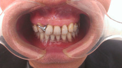 下颌覆盖义齿