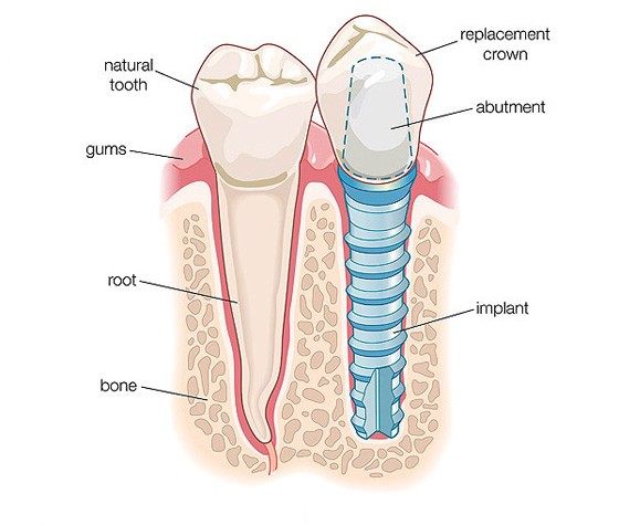 种植牙材质：纯钛的特点与优势
