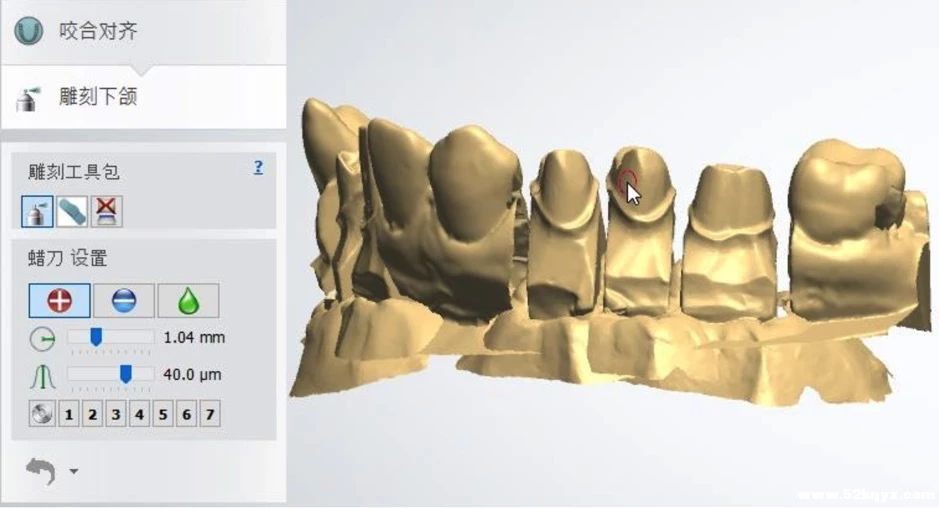 3Shape Dental System 2018 【操作方法】- 解剖型基台和螺丝固位冠
