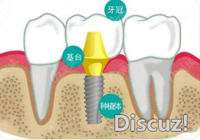 种植牙2.png