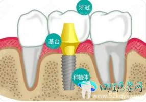 种植牙2.png